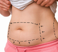 Liposuction - Skin and Recon