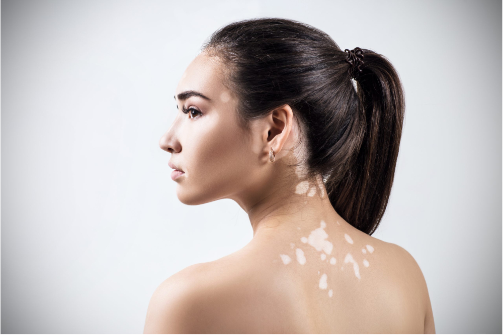 vitiligo treatment in Bangalore - skin and recon