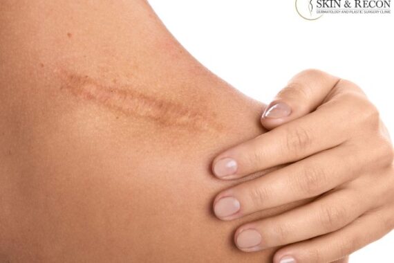 What are the problems with surgical scars?