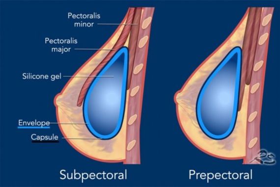 Debunking Common Myths About Breast Augmentation