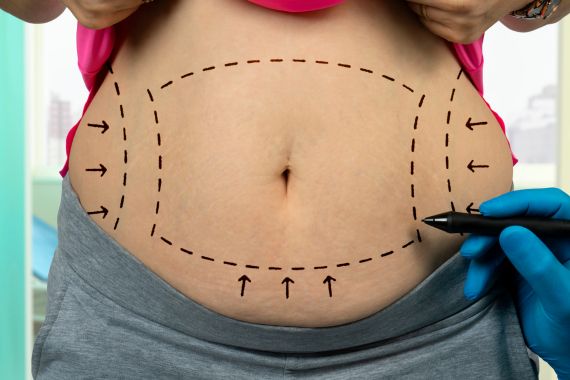 Why do people choose liposuction Surgery?