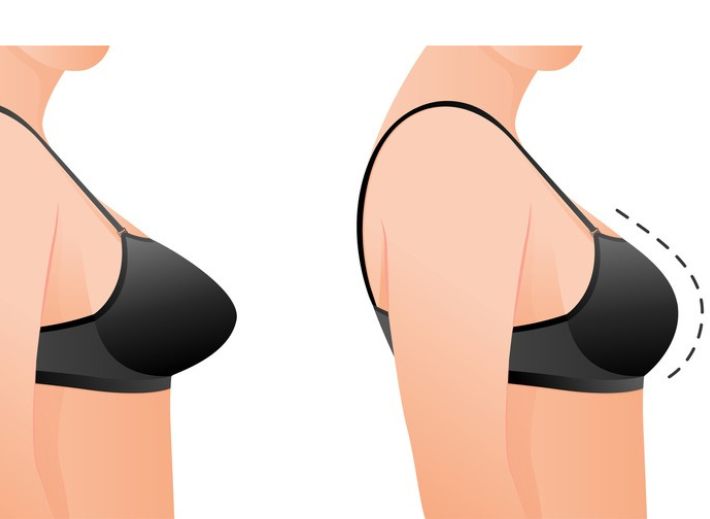 What to Expect After Breast Reduction Surgery