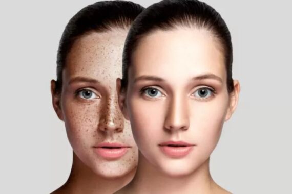 Understanding Various Kinds of Pigmentation