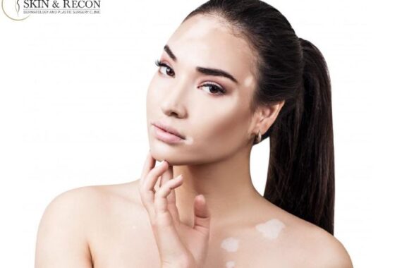 Understanding Vitiligo Surgery: Kinds and Operations