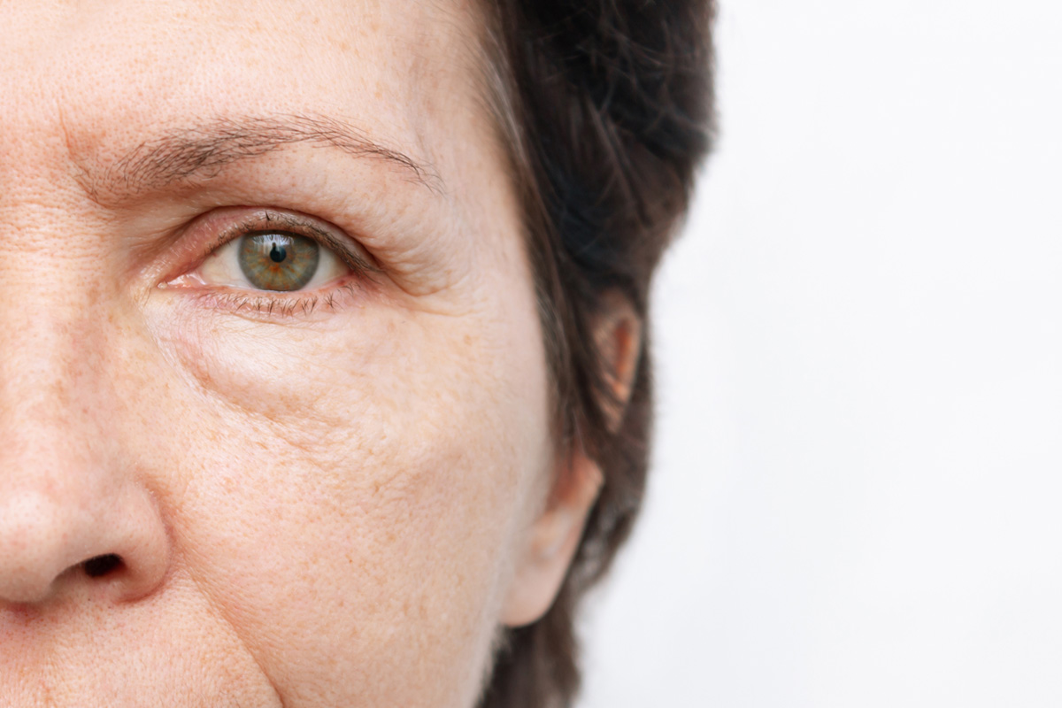 Blepharoplasty Surgery - Skin And Recon