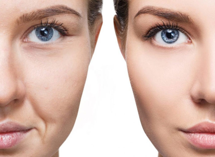 Facial Fat grafting Transfer before and after - Skin And Recon